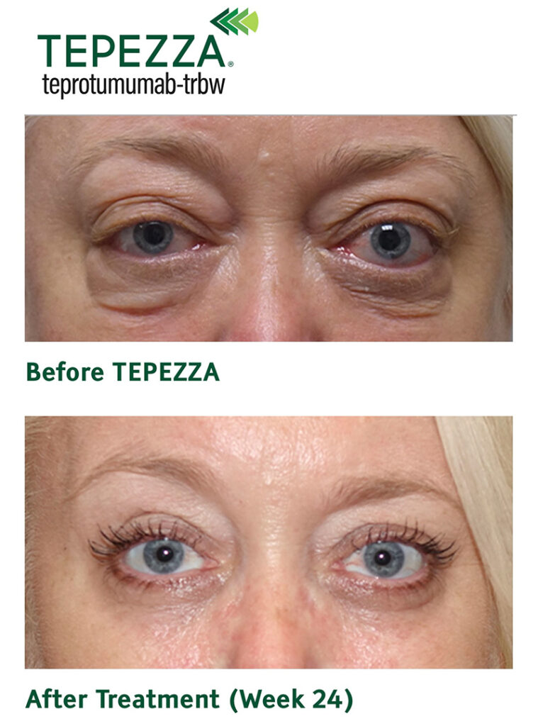 TEPEZZA for Thyroid Eye/Bulging Eye Diseases & Infusion Center